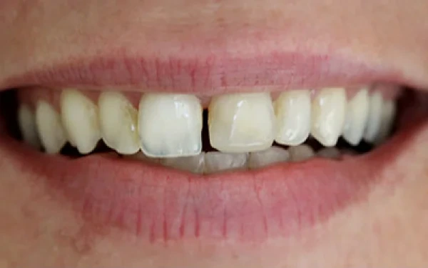 Home Dental Bonding Before 1