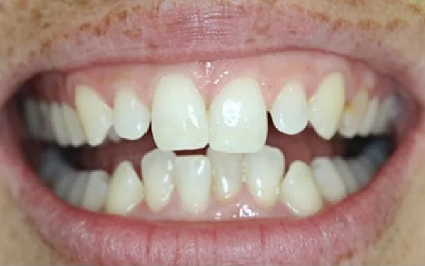 Home Invisalign Before 1