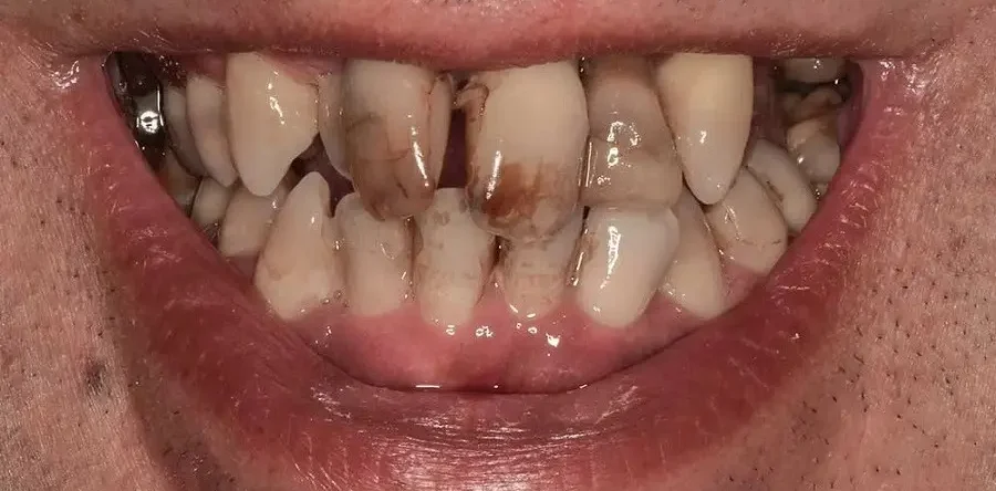 Home Veneers Case Before E1731415221418